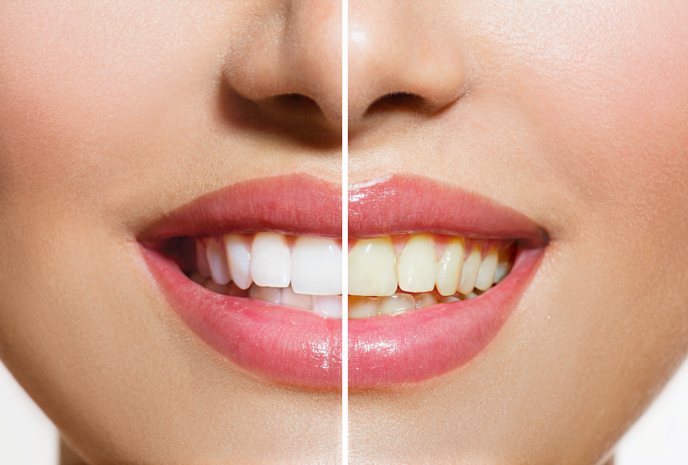 Stained Teeth | 77063 Dentist