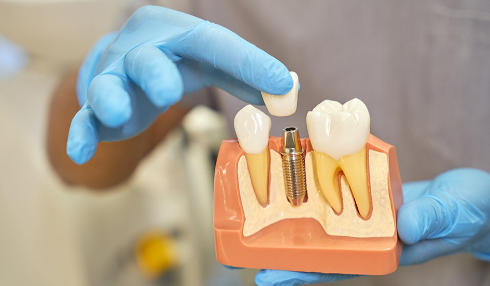 What are full-mouth dental implants and their benefits?