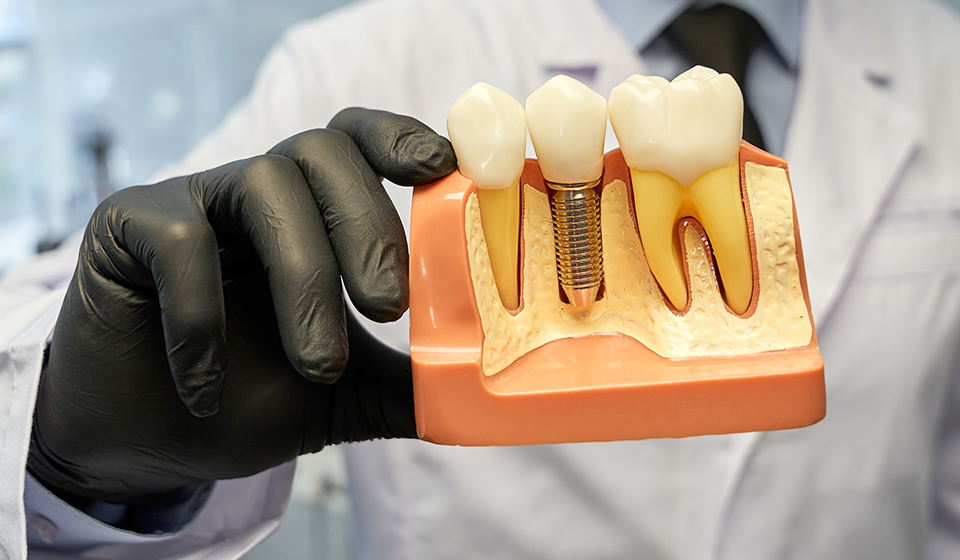What You Need To Know Before Getting Dental Implants: A Guide For First-Timers