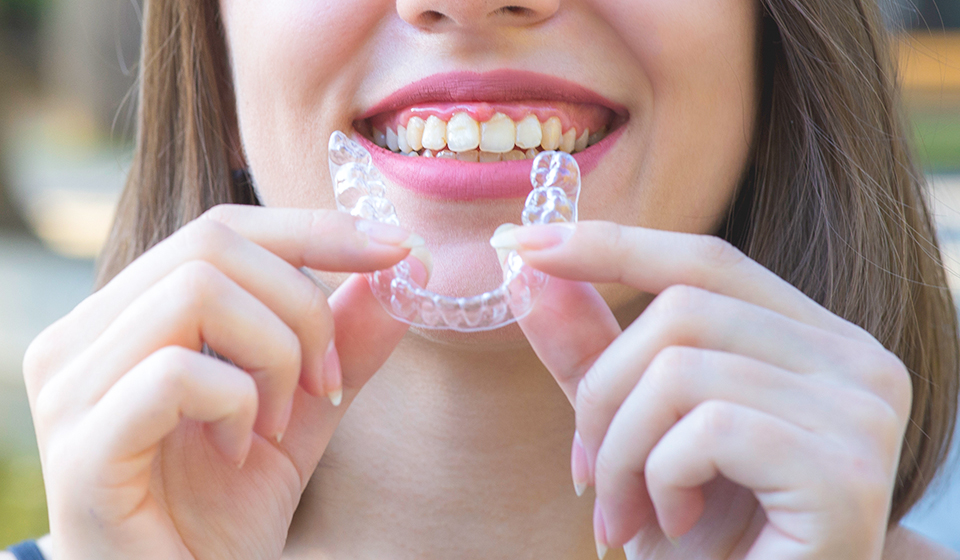 How Clear Braces Can Help Achieve Your Perfect Smile