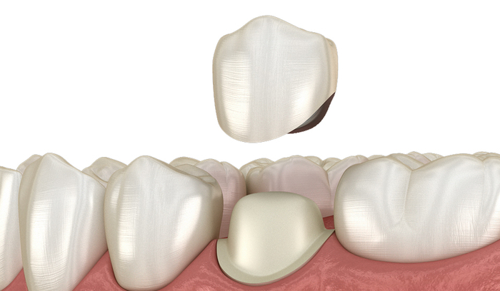 Dental Crown FAQs: Everything You Need to Know