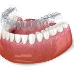 Westchase clear braces