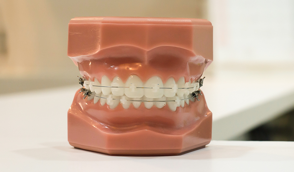 Clear Braces: A Proven Method for Straightening Teeth
