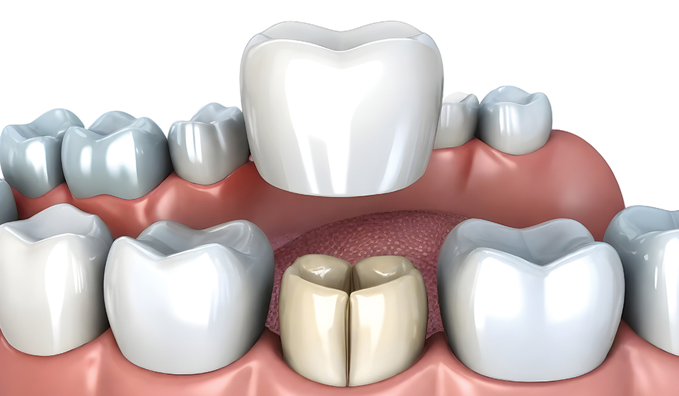 Frequently Asked Questions About Dental Crowns