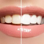 Professional Teeth Whitening