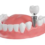 Dental implants in Westchase, TX