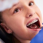 Dental braces in Westchase