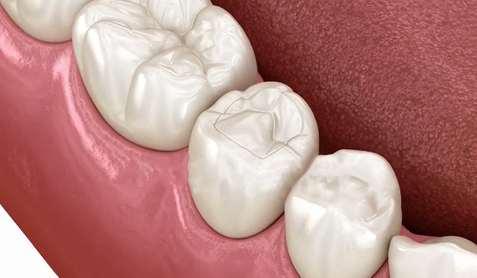 Benefits of Composite Fillings and How Do They Work?