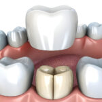 dental crowns dentist westchase tx