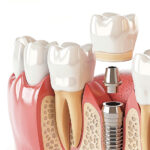 Dental implant surgery in Houston, TX