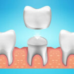 dental crowns in Houston