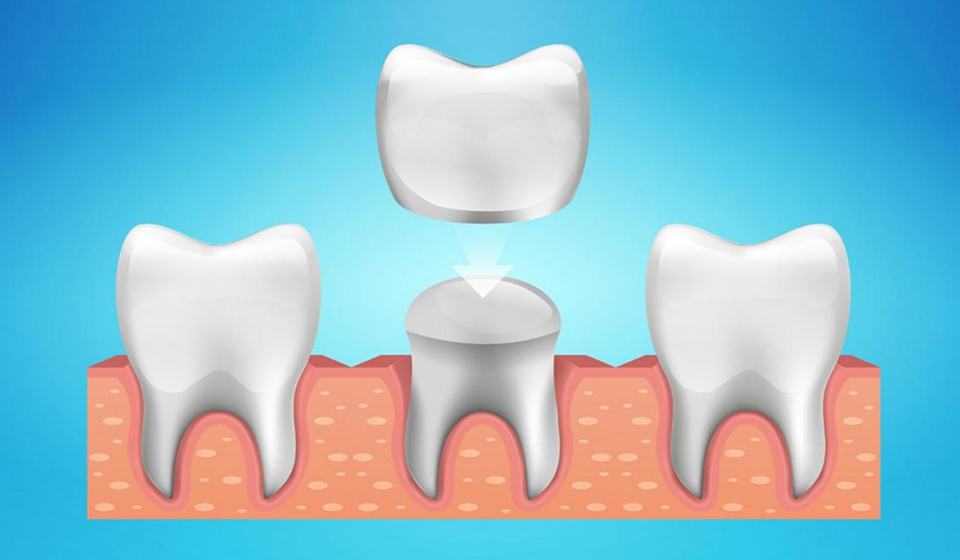 How Dental Crowns Are a Long-Term Solution for Damaged Teeth