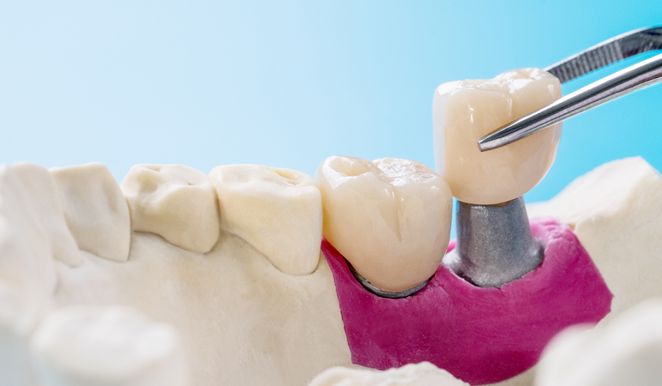 Before and After: The Life-Changing Effects of Dental Crowns