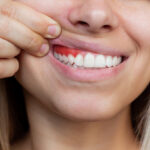 Gum Disease