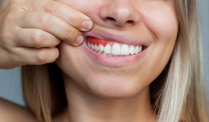5 Warning Signs of Gum Disease and Tips to Prevent It