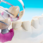 Dental Crown