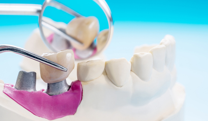 Dental Crown