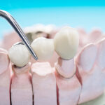 Dental Crowns