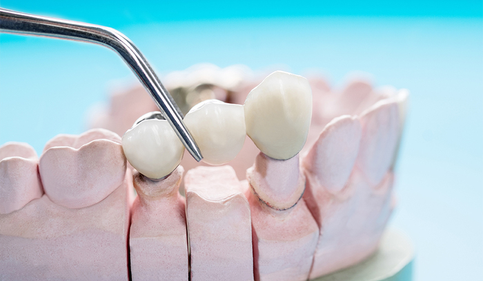 Dental Crowns