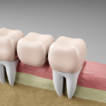 Custom Dental Bridge