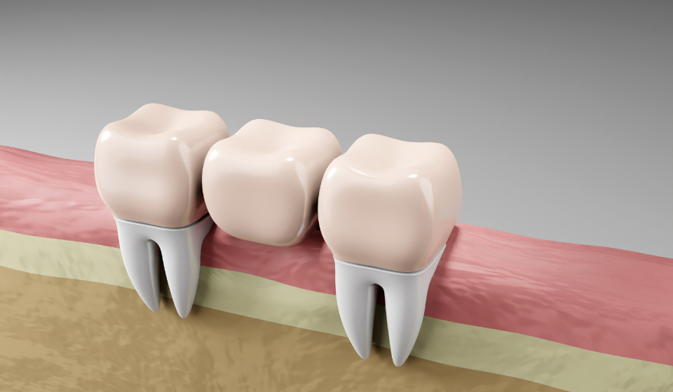 Custom Dental Bridge