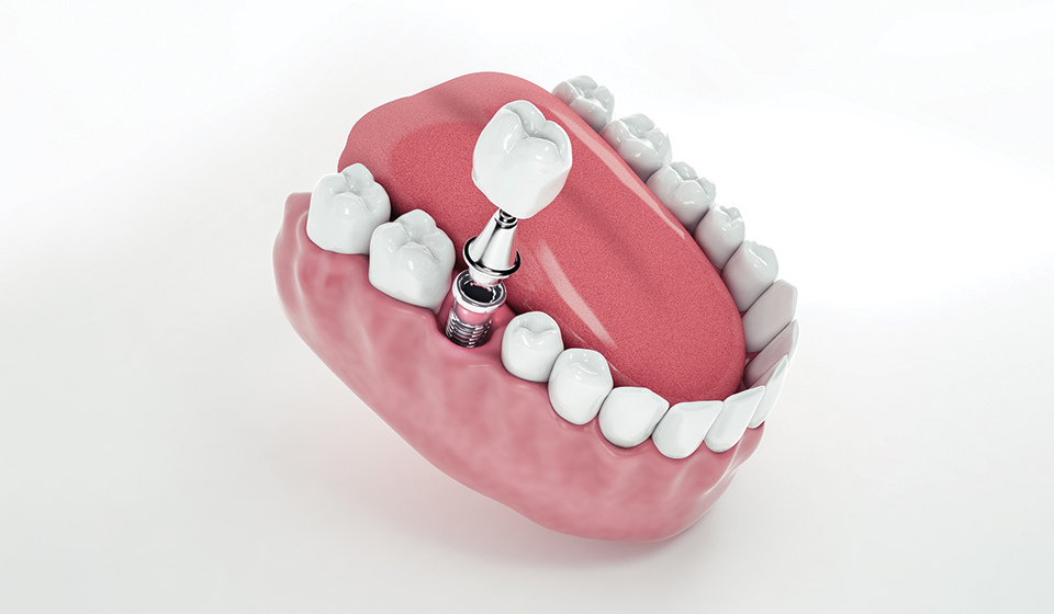 How Dental Implants Improve Comfort and Oral Health