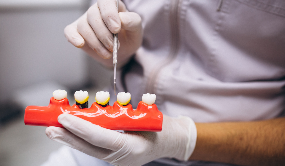 Dental Implants