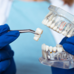 Dental Crowns
