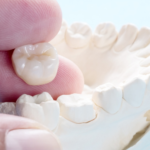 dental crown