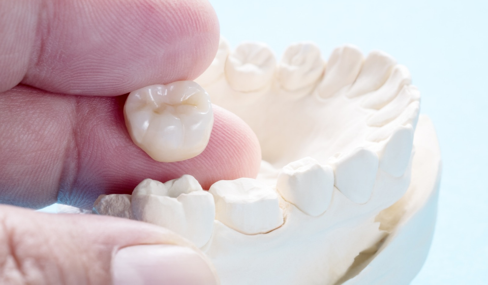 dental crown