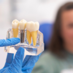 Dental implants
