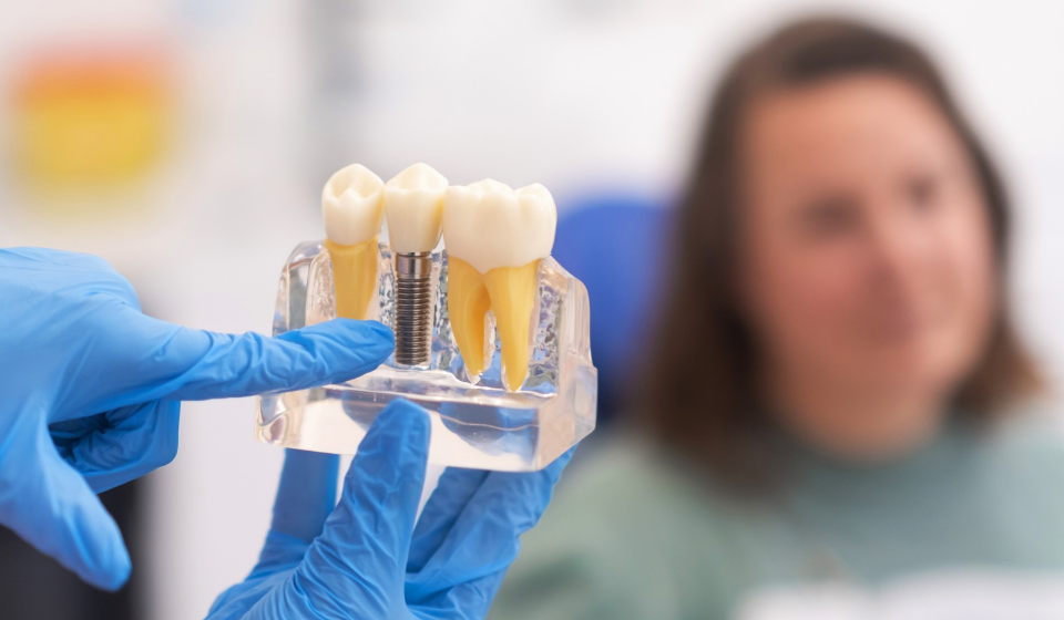 Dental implants